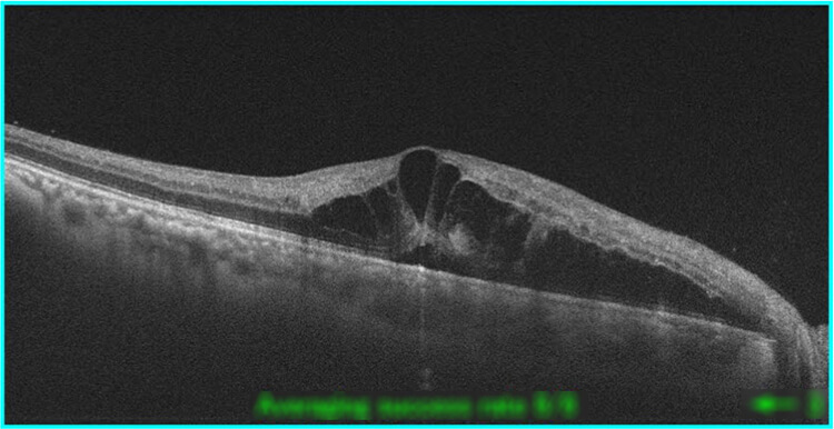 網膜光干渉断層計での測定